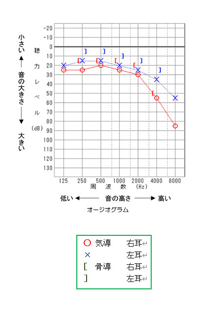 検査 聴力 聴力検査の1000Hz,4000Hzとは？聞こえない場合の原因は？