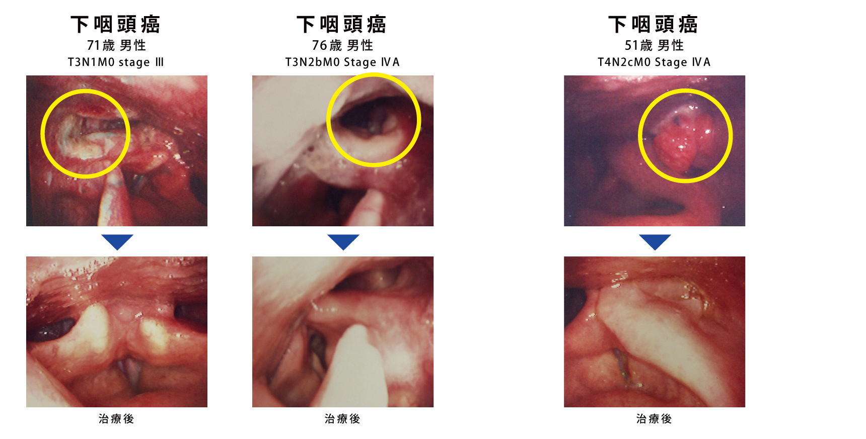 ん 初期 症状 喉頭 が » 喉頭がんの初期症状をチェックして早期発見する